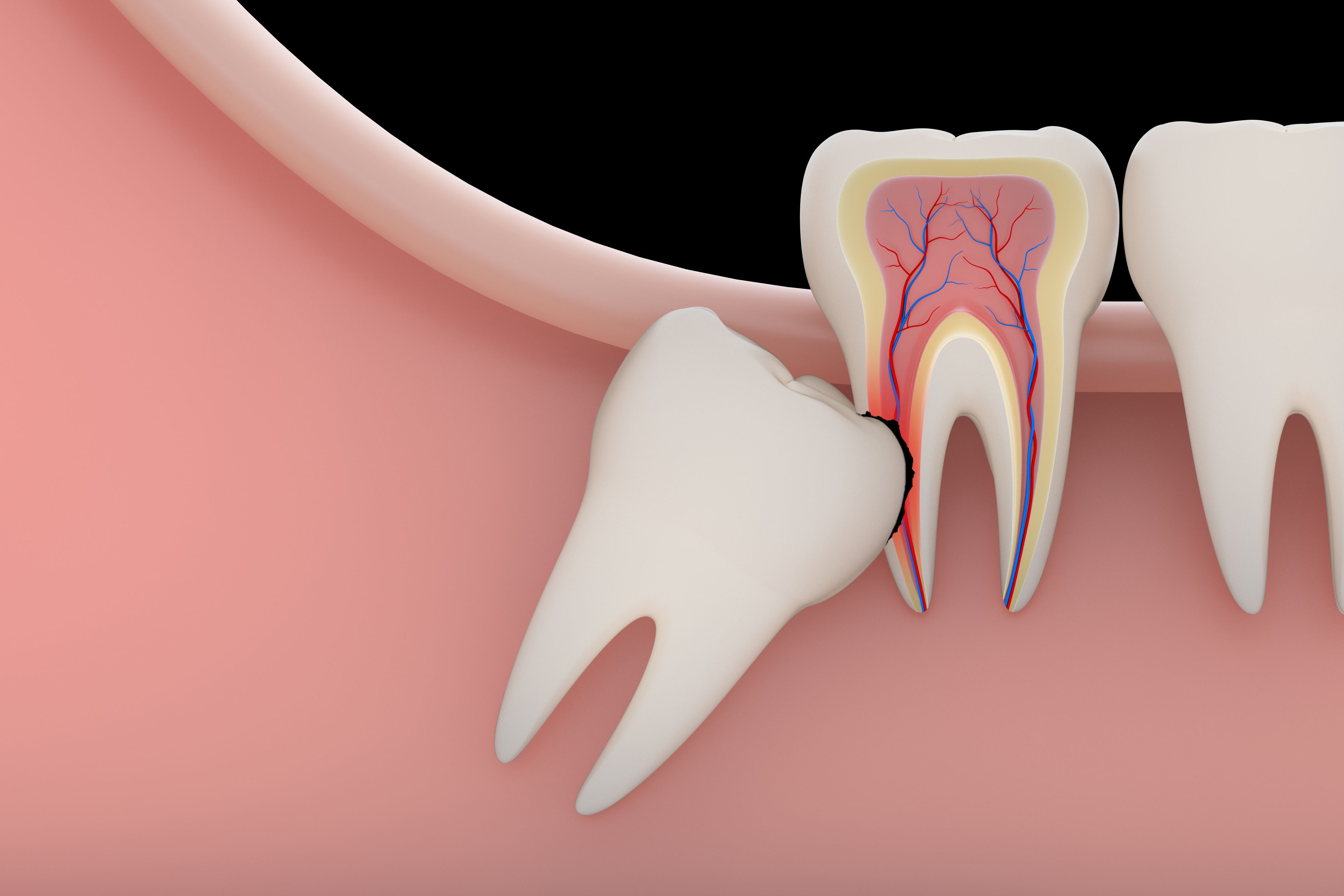Impacted wisdom tooth
