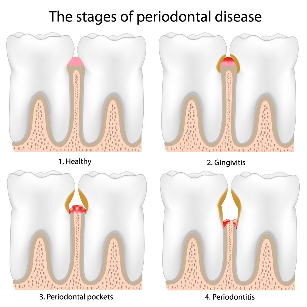 stages of periodontal disease