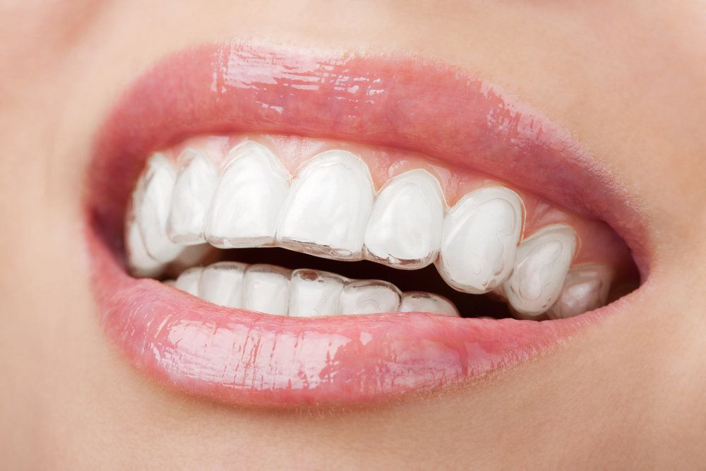 Clear aligner over woman's teeth