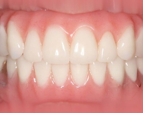 After denture