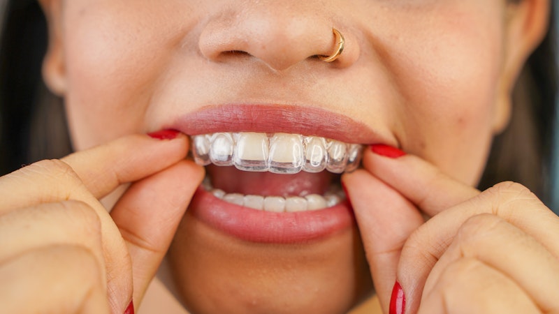 original_girl-placing-invisalign original_girl-placing-invisalign
